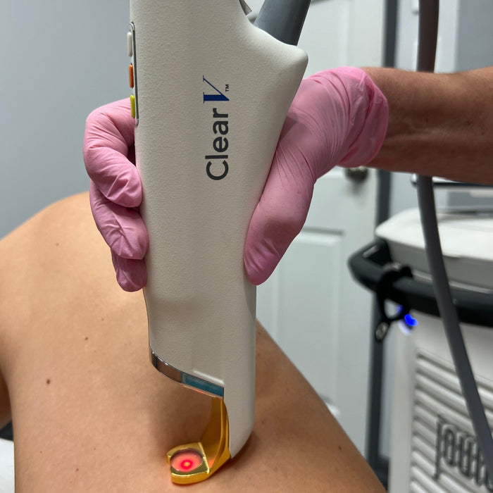 ClearV - MD Aesthetics